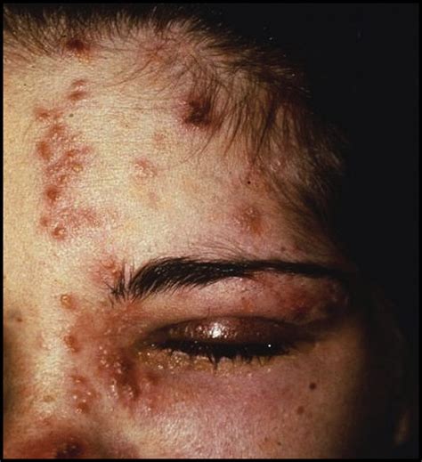 Herpes zoster ophthalmicus 